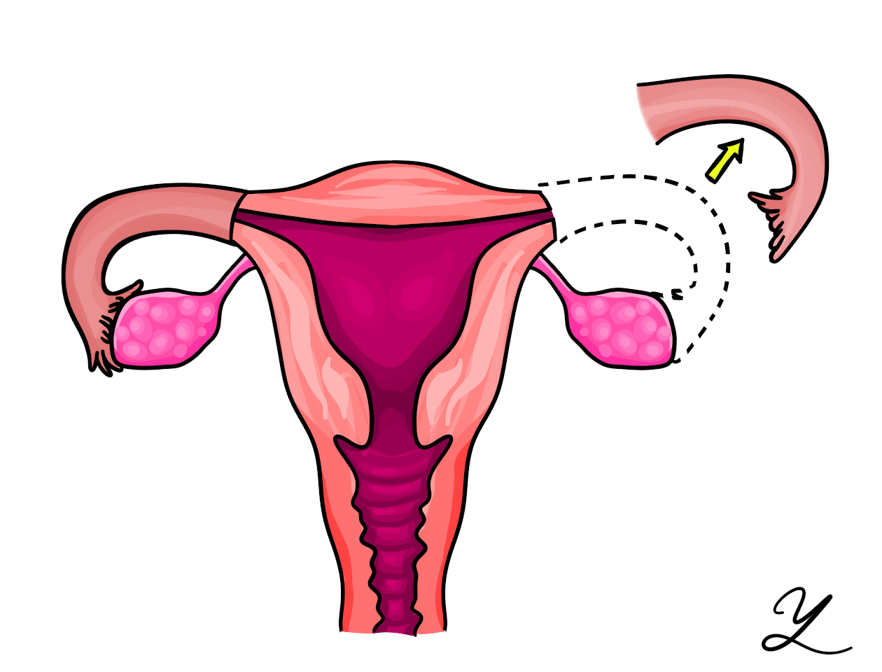 Удаление матки будут ли месячные. Резекция маточной трубы при внематочной беременности. Удаленная труба при внематочной беременности. Внематочная беременность в маточной трубе. Удаления маточной трубки внематочной беременности.